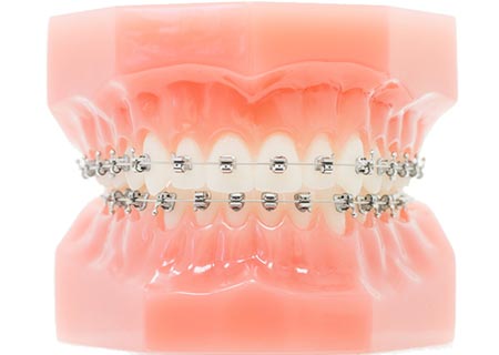 Kieferorthopädie Dr. Hellak feste Zahnspange Bracketsysteme SPEED