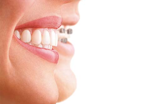 Kieferorthopädie Dr. Hellak INVISALIGN Teen System hochästhetische Behandlungsmethode