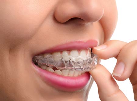 Kieferorthopädie Dr. Hellak INVISALIGN Teen System hochästhetische Behandlungsmethode