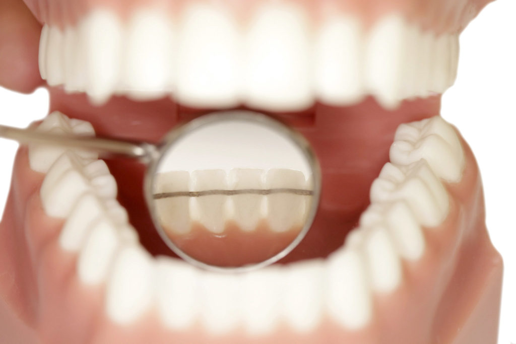 Kieferorthopädie Dr. Hellak Retainer